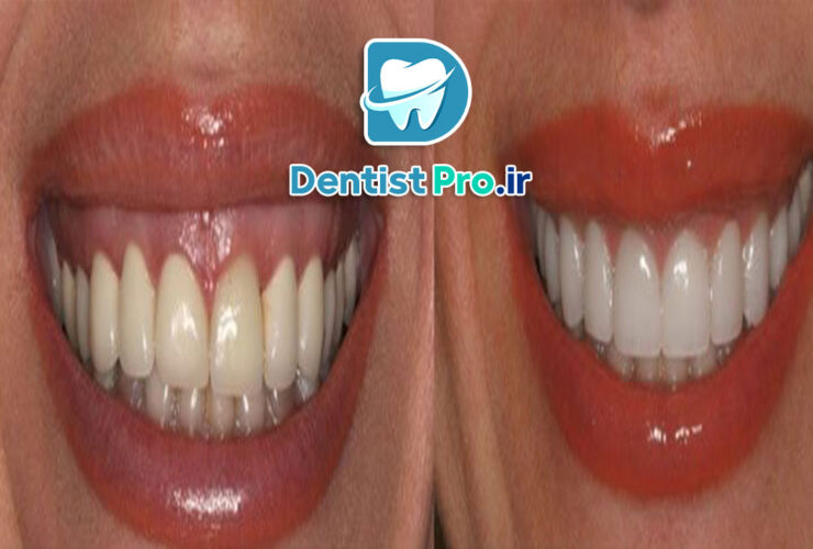 درمان التهاب لثه با لیزر پرتوان: راهنمای کامل 35 درمان التهاب لثه با لیزر پرتوان: راهنمای کامل