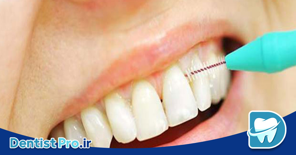 درمان التهاب لثه با لیزر پرتوان: راهنمای کامل 26 درمان التهاب لثه با لیزر پرتوان: راهنمای کامل