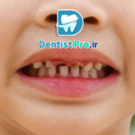 پوسیدگی دندان های شیری مقاوم به درمان: چالش‌ها، علل و راهکارهای موثر