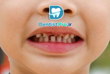 پوسیدگی دندان های شیری مقاوم به درمان: چالش‌ها، علل و راهکارهای موثر