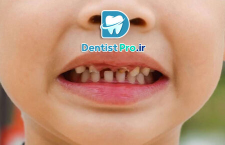 پوسیدگی دندان های شیری مقاوم به درمان: چالش‌ها، علل و راهکارهای موثر