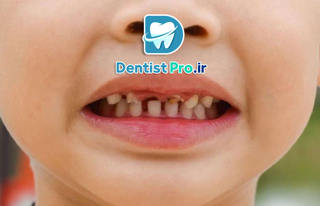 پوسیدگی دندان های شیری مقاوم به درمان: چالش‌ها، علل و راهکارهای موثر