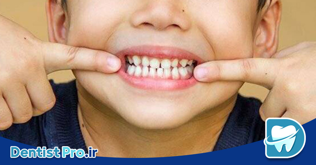 پوسیدگی دندان های شیری مقاوم به درمان: چالش‌ها، علل و راهکارهای موثر