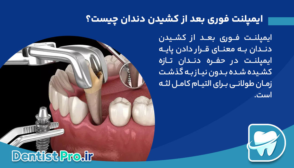 ایمپلنت فوری بعد از کشیدن دندان
