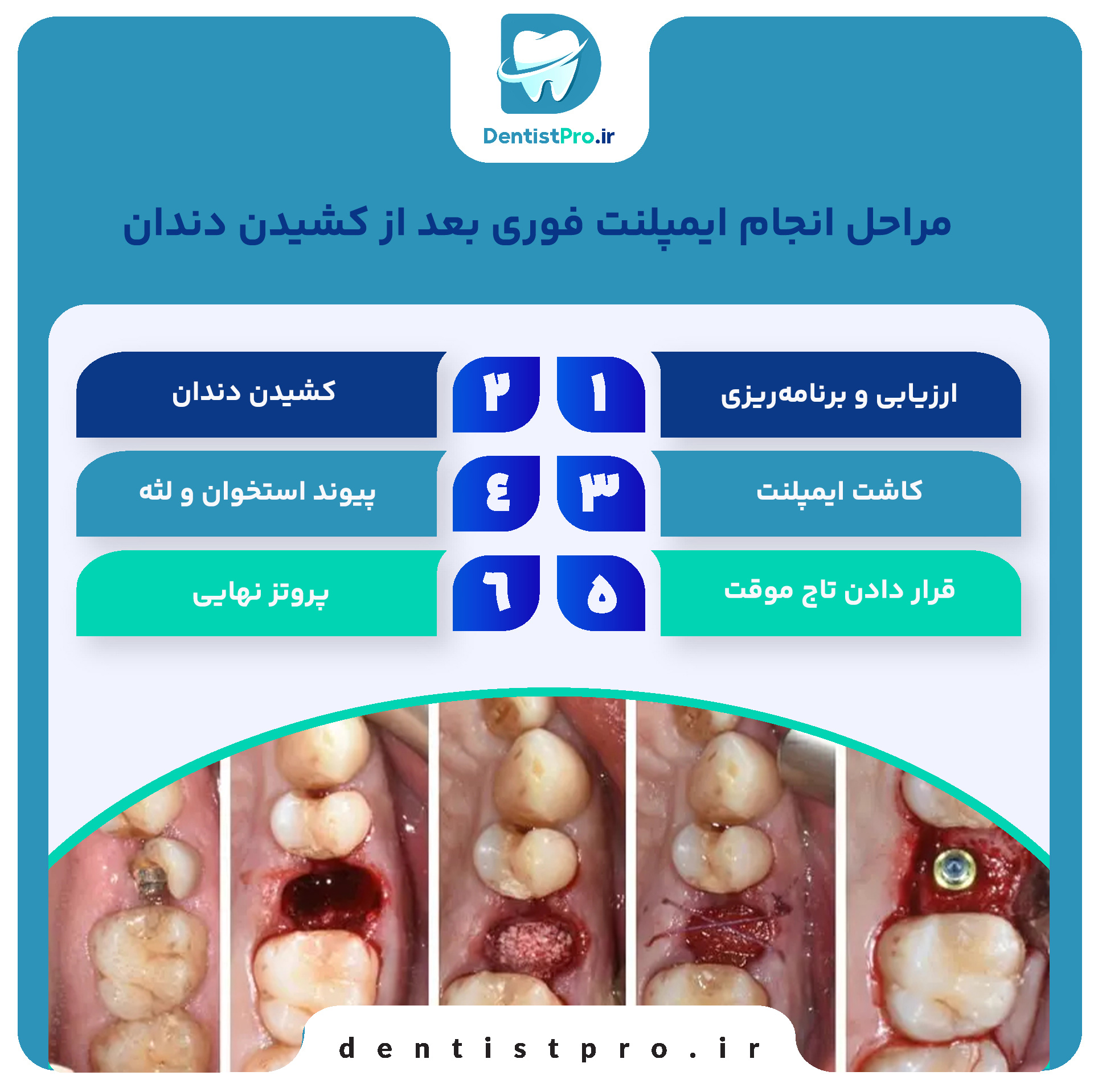 ایمپلنت فوری بعد از کشیدن دندان