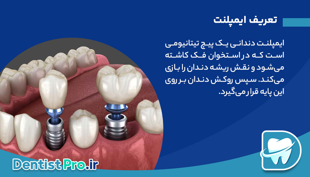 تفاوت ایمپلنت و بریج+بررسی 3 بعد مهم