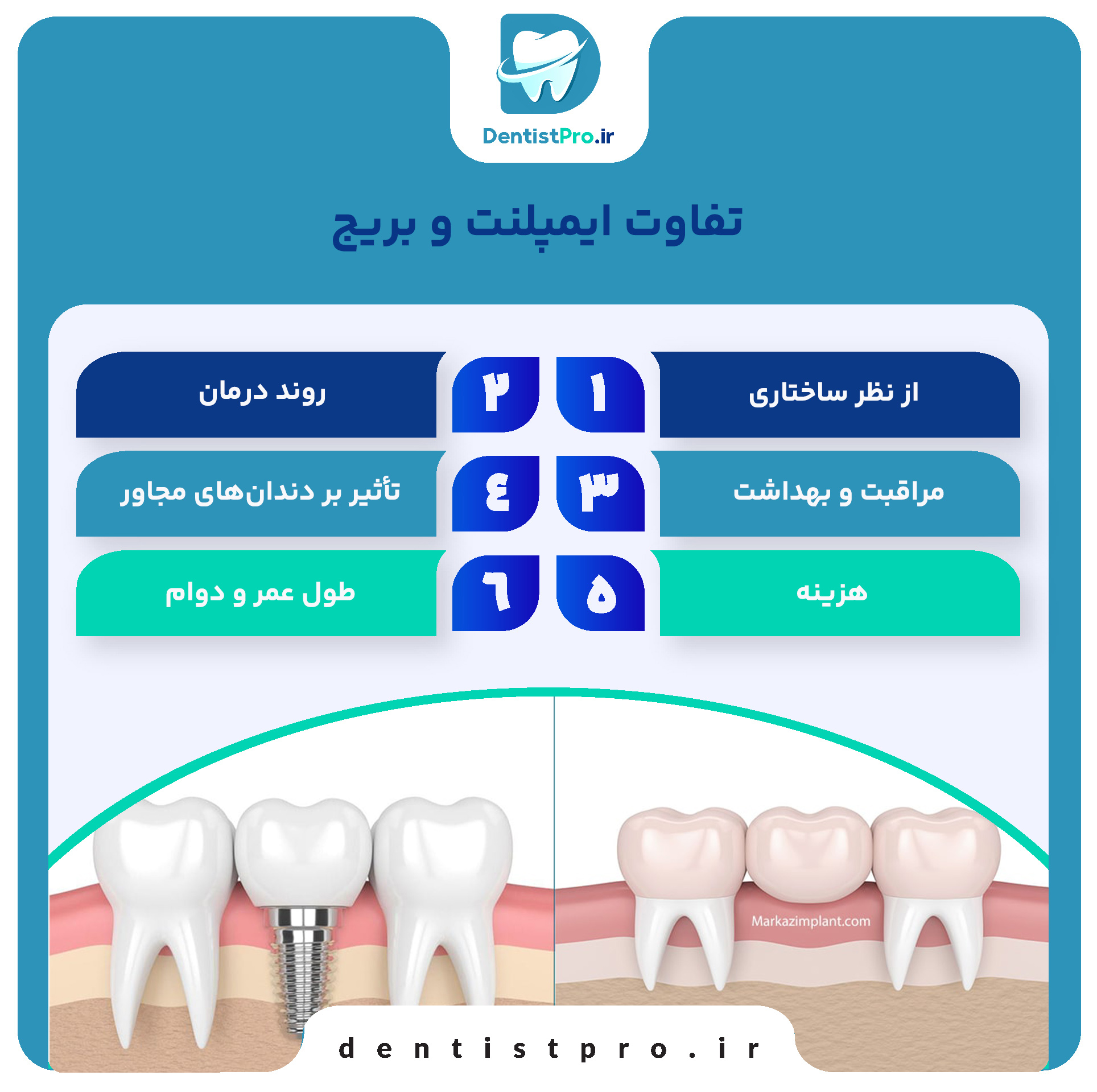 تفاوت ایمپلنت و بریج+بررسی 3 بعد مهم