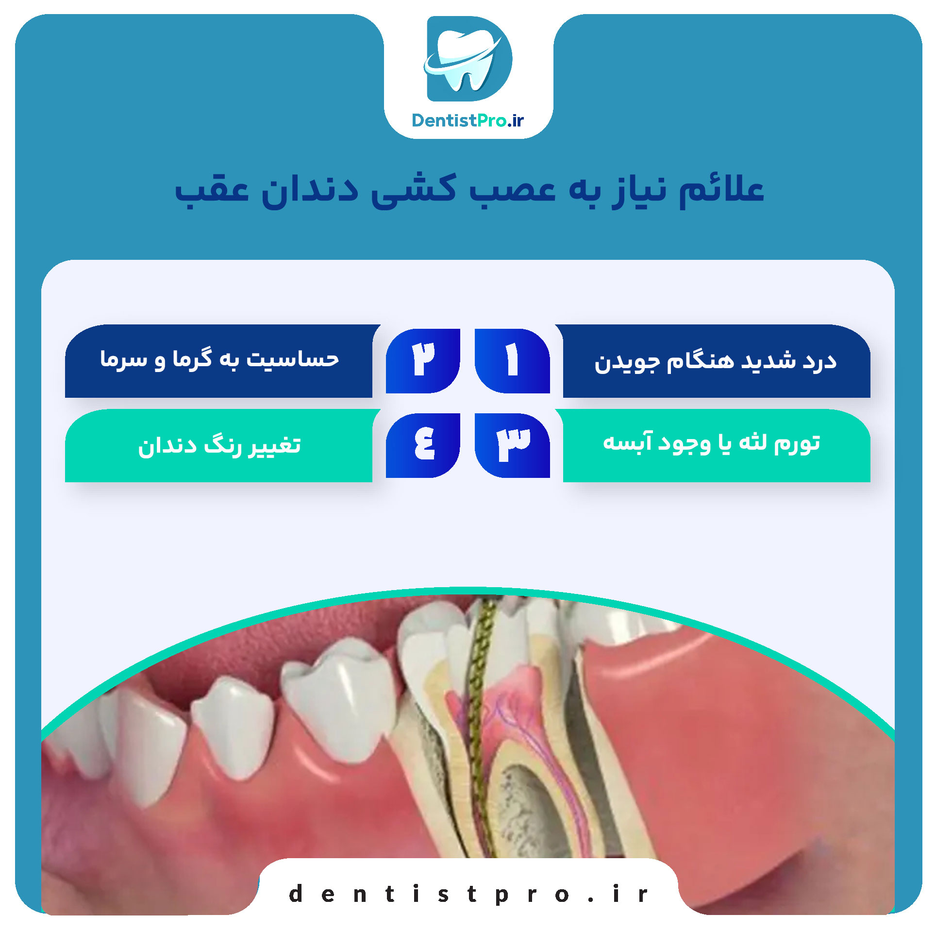 عصب کشی دندان عقب+مراحل آن چیست؟