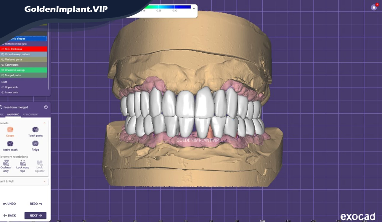 Digital implant sample in north of tehran - goldenimplant