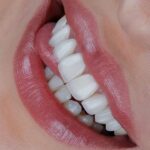 لمینت دندان در اصفهان؛ قیمت، انواع و بهترین انتخاب برای لبخند زیبا
