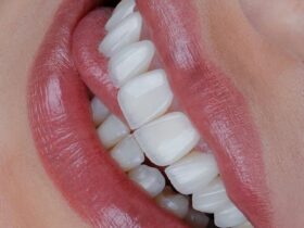 لمینت دندان در اصفهان؛ قیمت، انواع و بهترین انتخاب برای لبخند زیبا