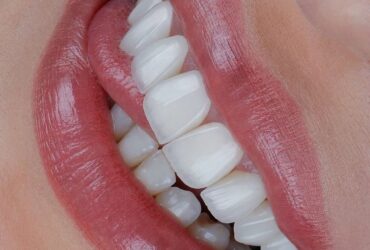 لمینت دندان در اصفهان؛ قیمت، انواع و بهترین انتخاب برای لبخند زیبا