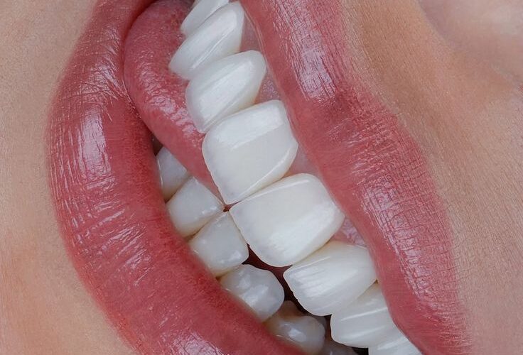 لمینت دندان در اصفهان؛ قیمت، انواع و بهترین انتخاب برای لبخند زیبا