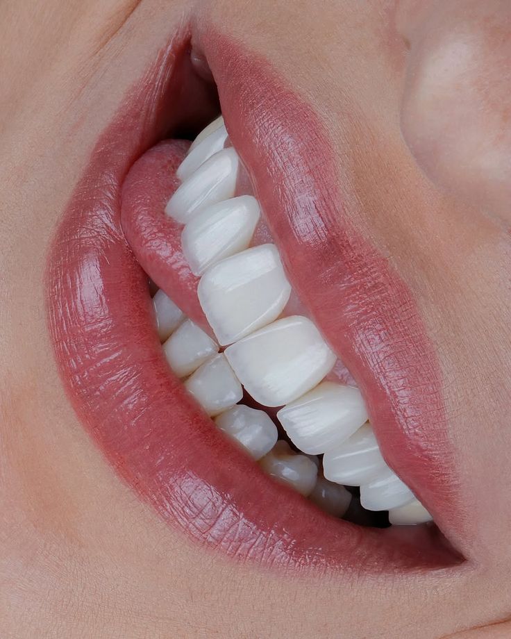 لمینت دندان در اصفهان؛ قیمت، انواع و بهترین انتخاب برای لبخند زیبا