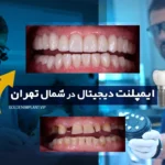 ایمپلنت دیجیتال در شمال تهران؛ تجربه کاشت دندان دقیق و بدون درد