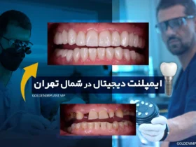 ایمپلنت دیجیتال در شمال تهران؛ تجربه کاشت دندان دقیق و بدون درد
