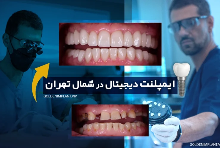 ایمپلنت دیجیتال در شمال تهران؛ تجربه کاشت دندان دقیق و بدون درد