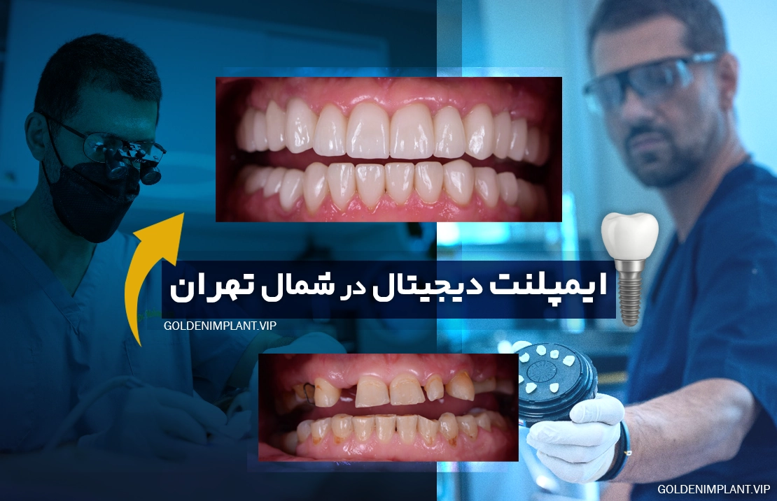 ایمپلنت دیجیتال در شمال تهران؛ تجربه کاشت دندان دقیق و بدون درد