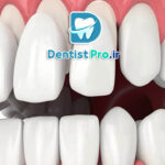 مزایای لمینت نسبت به ونیر کامپوزیتی طولانی مدت