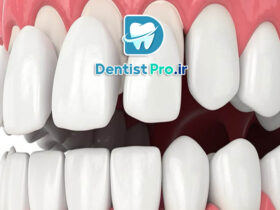 مزایای لمینت نسبت به ونیر کامپوزیتی طولانی مدت