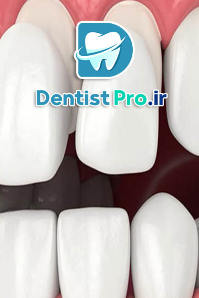 مزایای لمینت نسبت به ونیر کامپوزیتی طولانی مدت