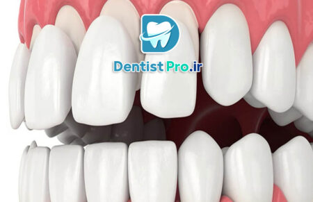 مزایای لمینت نسبت به ونیر کامپوزیتی طولانی مدت