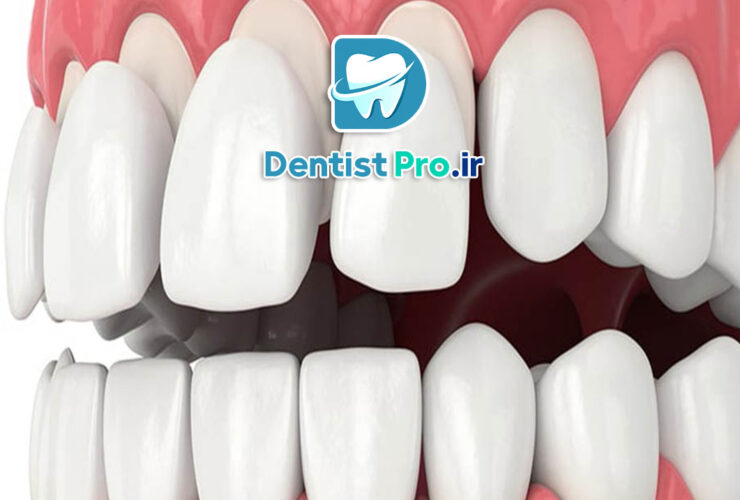مزایای لمینت نسبت به ونیر کامپوزیتی طولانی مدت