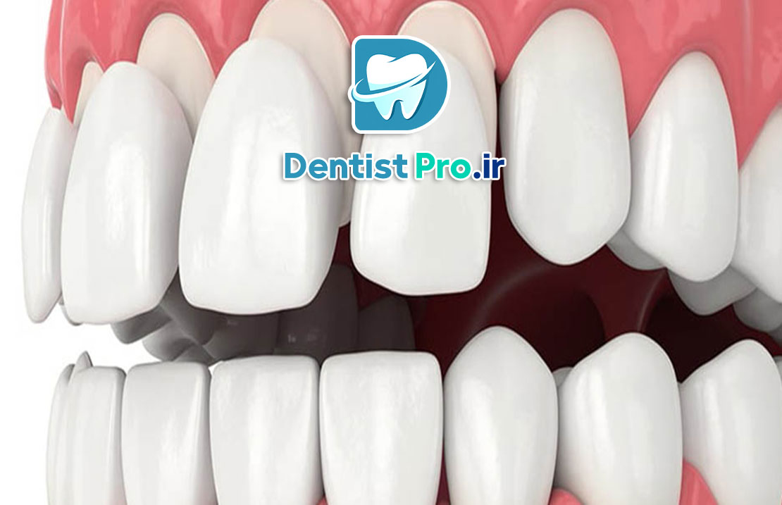 مزایای لمینت نسبت به ونیر کامپوزیتی طولانی مدت