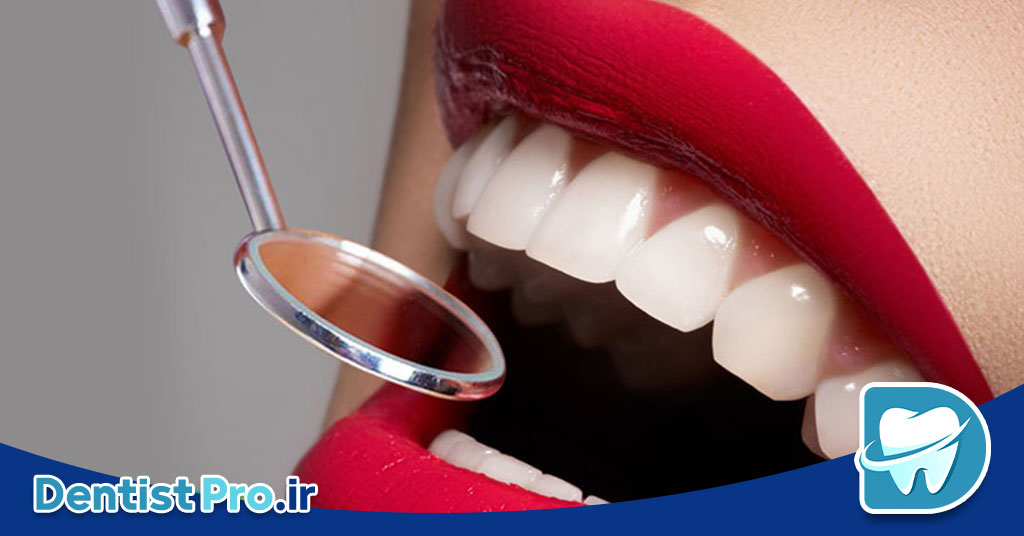 مزایای لمینت نسبت به ونیر کامپوزیتی طولانی مدت