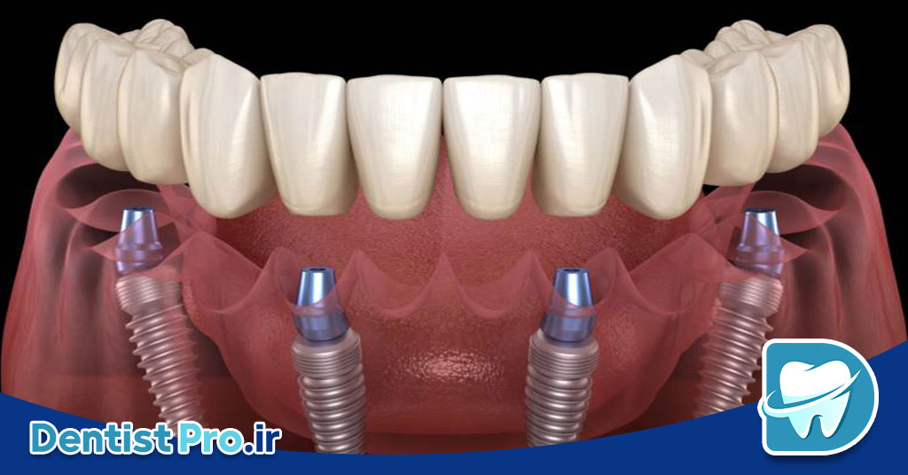 ایمپلنت All-on-4 برای بی دندان های کامل