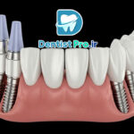 ایمپلنت All-on-4 برای بی دندان های کامل