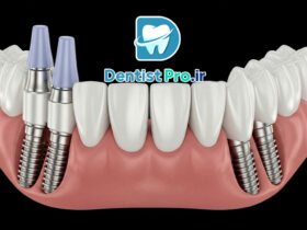 ایمپلنت All-on-4 برای بی دندان های کامل