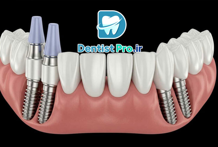 ایمپلنت All-on-4 برای بی دندان های کامل