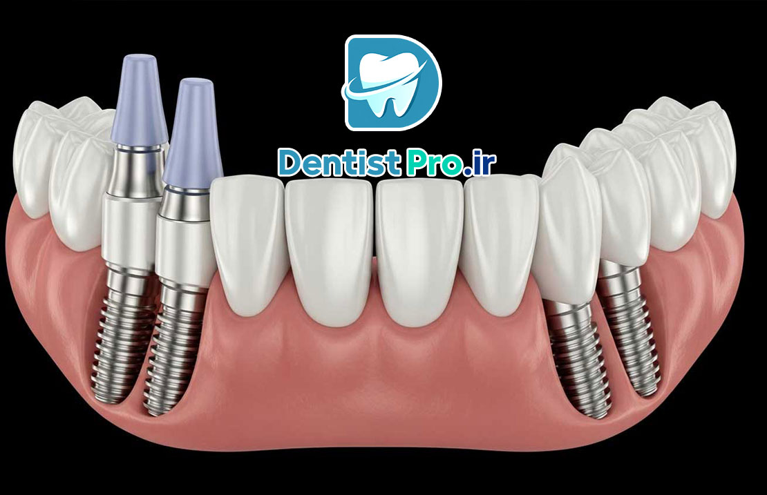 ایمپلنت All-on-4 برای بی دندان های کامل