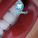 زیباتر کردن لبخند با لمینت و طراحی دیجیتال