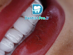 زیباتر کردن لبخند با لمینت و طراحی دیجیتال