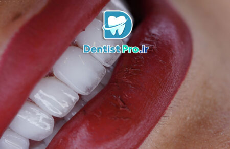 زیباتر کردن لبخند با لمینت و طراحی دیجیتال