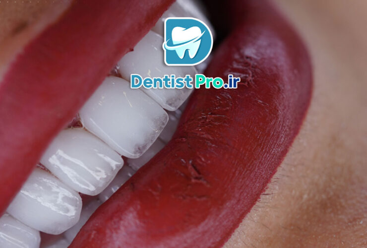 زیباتر کردن لبخند با لمینت و طراحی دیجیتال 27 زیباتر کردن لبخند با لمینت و طراحی دیجیتال