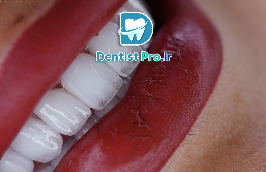 زیباتر کردن لبخند با لمینت و طراحی دیجیتال