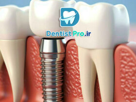 بهترین برند ایمپلنت برای استخوان ضعیف فک