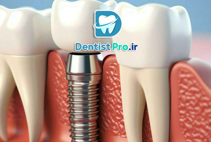 بهترین برند ایمپلنت برای استخوان ضعیف فک 30 بهترین برند ایمپلنت برای استخوان ضعیف فک