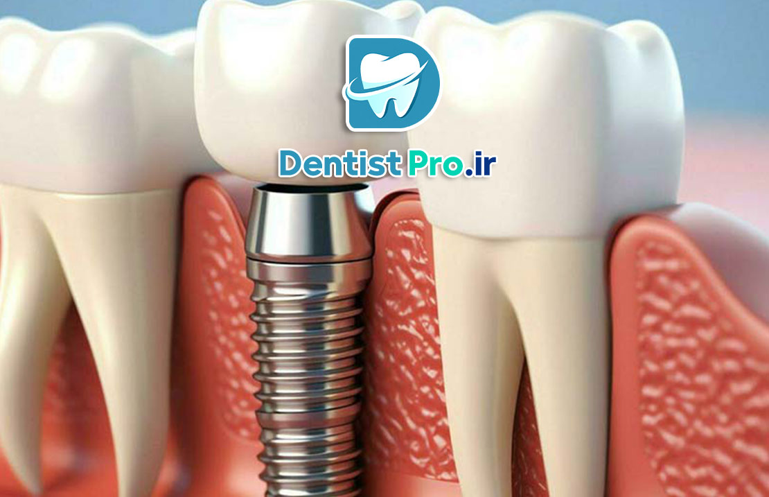 بهترین برند ایمپلنت برای استخوان ضعیف فک