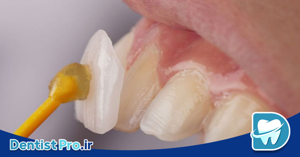 لمینت سرامیکی با ضخامت کم و ماندگاری بالا 26 لمینت سرامیکی با ضخامت کم و ماندگاری بالا