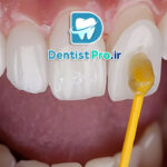 لمینت سرامیکی با ضخامت کم و ماندگاری بالا