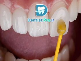 لمینت سرامیکی با ضخامت کم و ماندگاری بالا