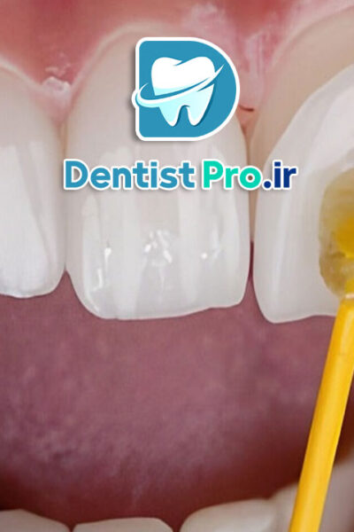 لمینت سرامیکی با ضخامت کم و ماندگاری بالا