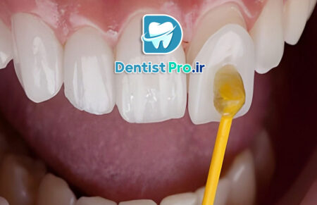 لمینت سرامیکی با ضخامت کم و ماندگاری بالا