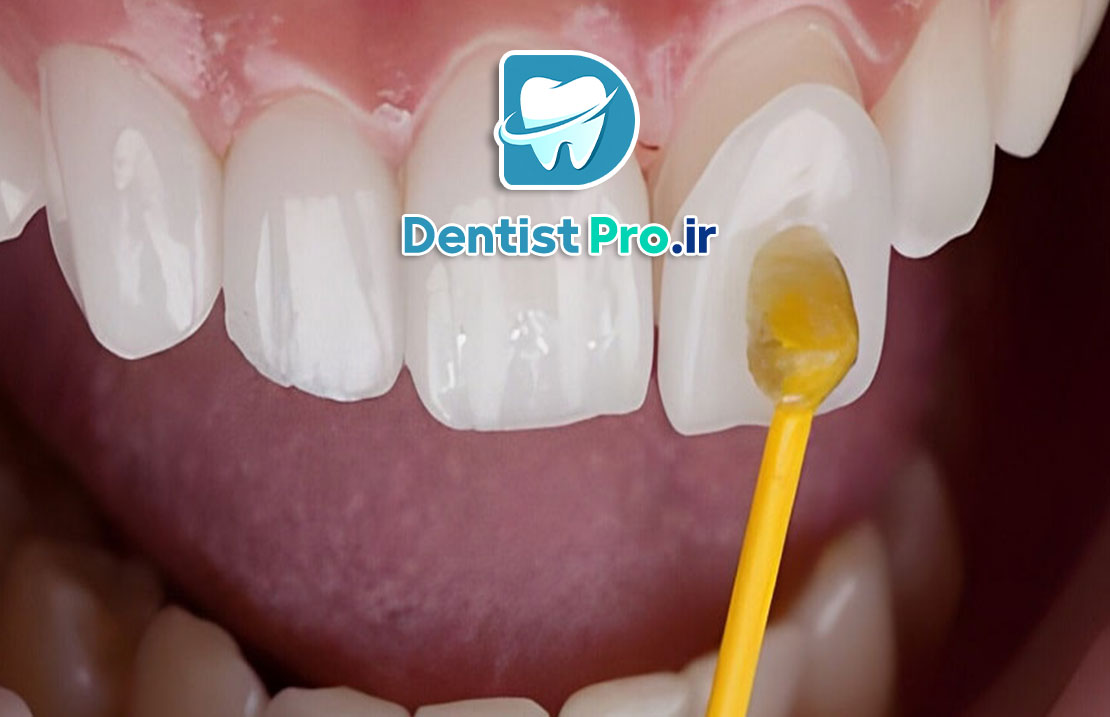 لمینت سرامیکی با ضخامت کم و ماندگاری بالا 25 لمینت سرامیکی با ضخامت کم و ماندگاری بالا