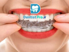 ارتودنسی شفاف بدون دیده شدن براکت ها در لبخند: راهنمای کامل برای لبخند زیبا