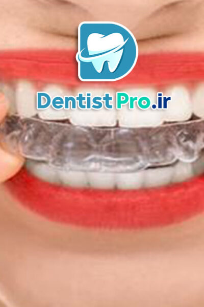 ارتودنسی شفاف بدون دیده شدن براکت ها در لبخند: راهنمای کامل برای لبخند زیبا